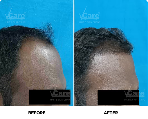 Graft-implantation-process